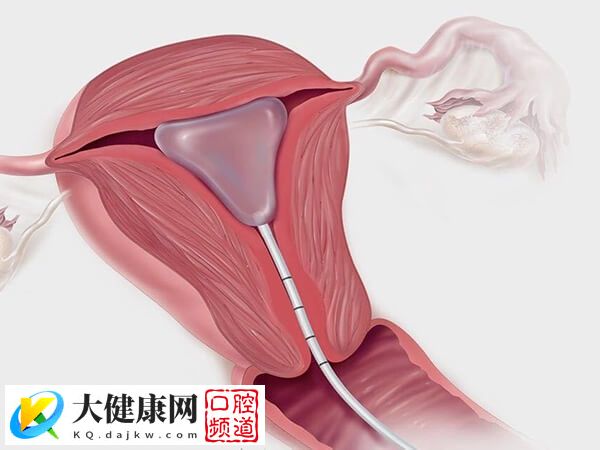 积极治疗可预防宫腔粘连